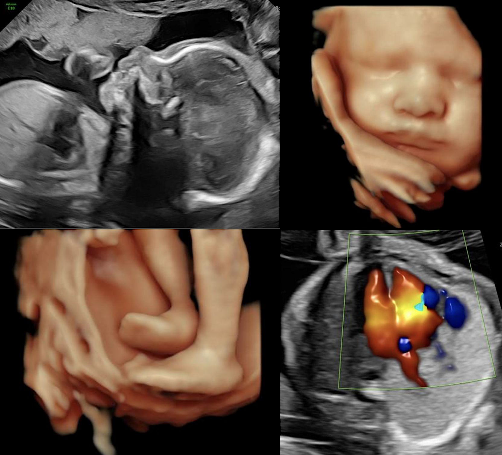 Image d'échographie fœtale 3D réalisée avec l'appareil Voluson E10 au cabinet du Dr Hilmi à Nice